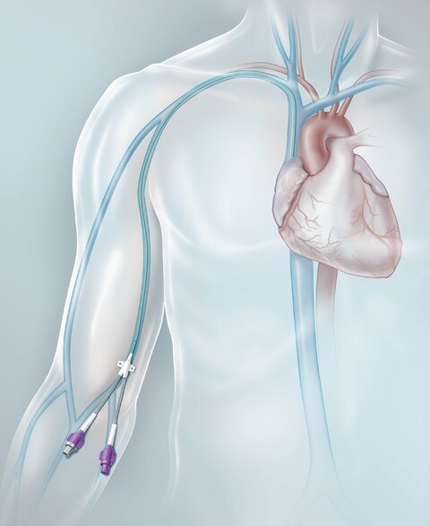 Picc-Illustration